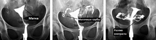 Изображение 3: Промывание маточных труб у женщин - ЭКО-блог