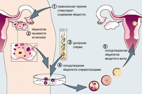 Изображение 1: Процедура ЭКО.