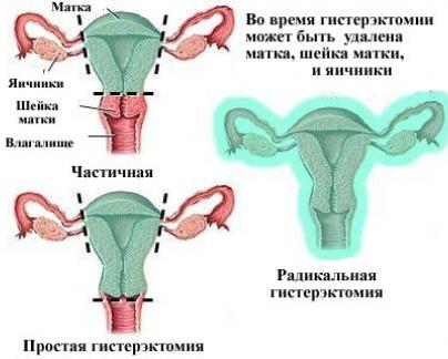 Изображение 2: Удаление матки при миоме