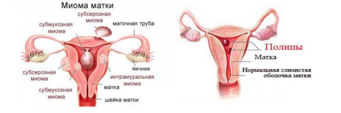 Изображение 1: Чем полип отличается от миомы - ЭКО-блог