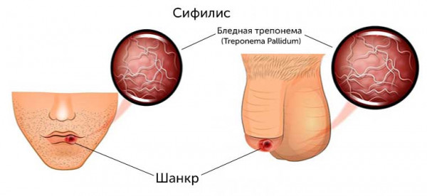 Изображение 2: Инфекционные заболевания у мужчин