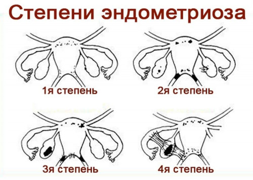 Изображение 1: Эко при эндометриозе матки - ЭКО-блог