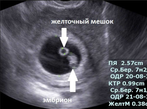 Изображение 1: Развитие плода в 1 месяце беременности