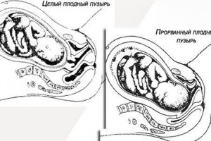 Изображение 2: Падения при беременности - ЭКО-блог