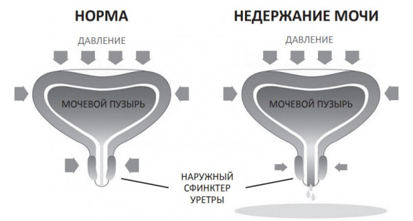 Изображение 2: Недержание мочи после родов - ЭКО-блог