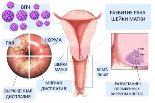 Изображение 1: Папиллома и беременность - ЭКО-блог