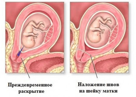 Изображение 1: Пессарии в акушерстве - ЭКО-блог