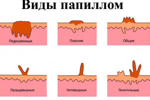 Изображение 2: Вирус папилломы у женщин - ЭКО-блог