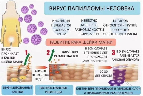 Изображение 2: Вирус папилломы у женщин - ЭКО-блог