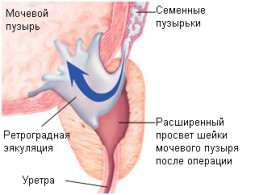 Изображение 1: Ретроградная эякуляция - ЭКО-блог