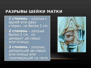 Изображение 2: Шейка матки после родов - ЭКО-блог
