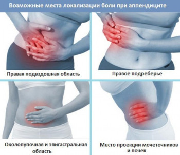 Изображение 1: Аппендицит при беременности - ЭКО-блог