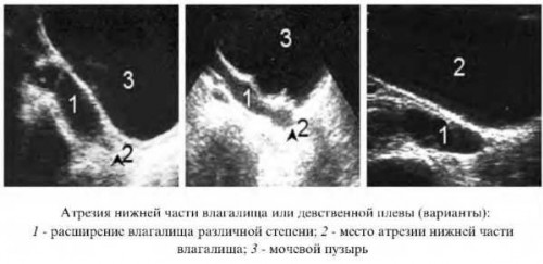 Изображение 2: Атрезия влагалища - ЭКО-блог