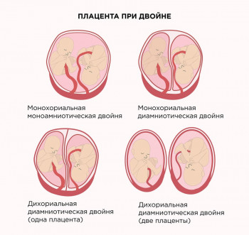 Изображение 1: Инфаркт плаценты - ЭКО-блог