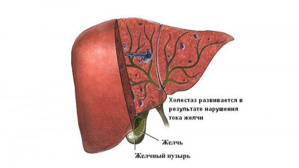 Изображение 1: Холестаз - ЭКО-блог