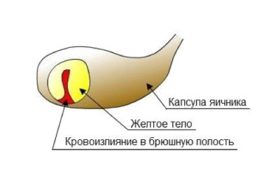 Изображение 1: Апоплексия яичника - к чему приводит? - ЭКО-блог
