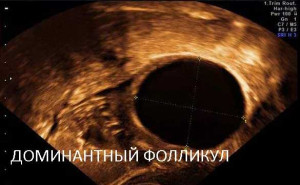 Изображение : Что такое доминантный фолликул - ЭКО-блог
