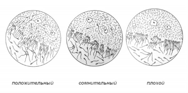 Изображение : Проба Курцрока-Миллера: тест на совместимость - ЭКО-блог