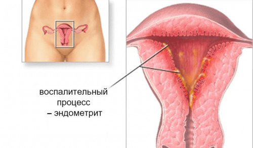 Изображение 4: Субинволюция матки - ЭКО-блог
