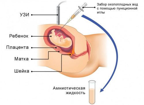 Изображение 3: Фенилкетонурия - ЭКО-блог