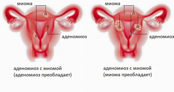 Изображение 4: Аденомиоз матки - ЭКО-блог