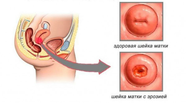 Изображение : Эрозия шейки матки - ЭКО-блог