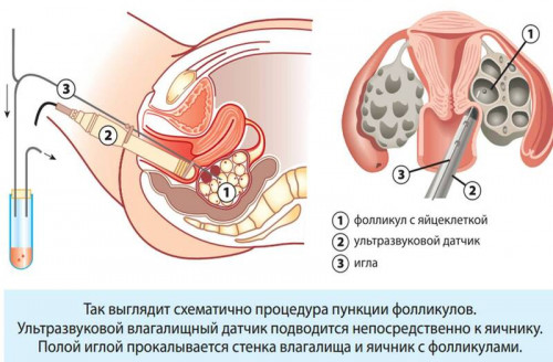 Изображение 2: Криоконсервация ооцитов - ЭКО-блог