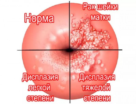 Изображение 5: Кольпоскопия - ЭКО-блог
