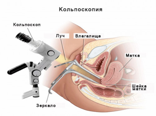 Изображение 4: Кольпоскопия - ЭКО-блог