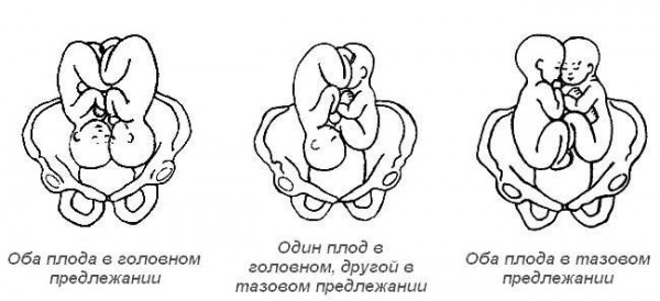 Изображение 4: Многоплодная беременность - ЭКО-блог