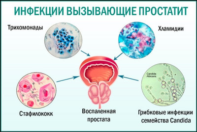 Изображение 1: Простатит - ЭКО-блог