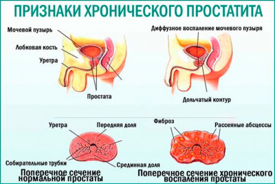 Изображение 5: Простатит  - ЭКО-блог