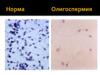 Изображение 1: Олигоспермия у мужчин - ЭКО-блог