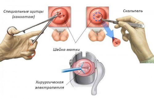 Изображение 2: Биопсия шейки матки - ЭКО-блог