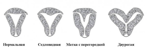 Изображение 2: Двурогая матка - ЭКО-блог