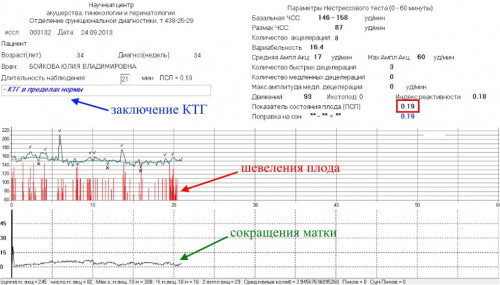 Изображение 3: КТГ при беременности - ЭКО-блог