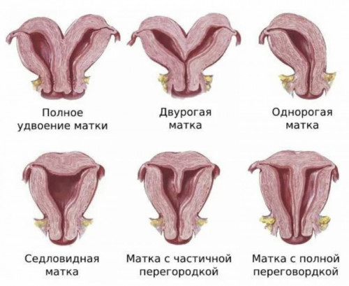 Изображение 2: Патология матки - ЭКО-блог