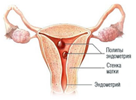Полип эндометрия что это и как лечить
