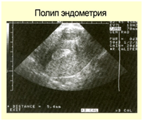 Полип эндометрия что это и как лечить